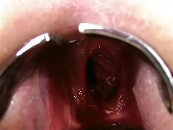 Kumenya kaŵiri kwa m'makutu, prolapse, galasi lakupangika panyumba.